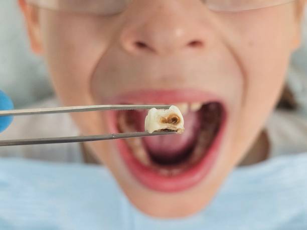 Best Emergency Dental Care for Broken or Chipped Teeth in Cayuga Heights, NY